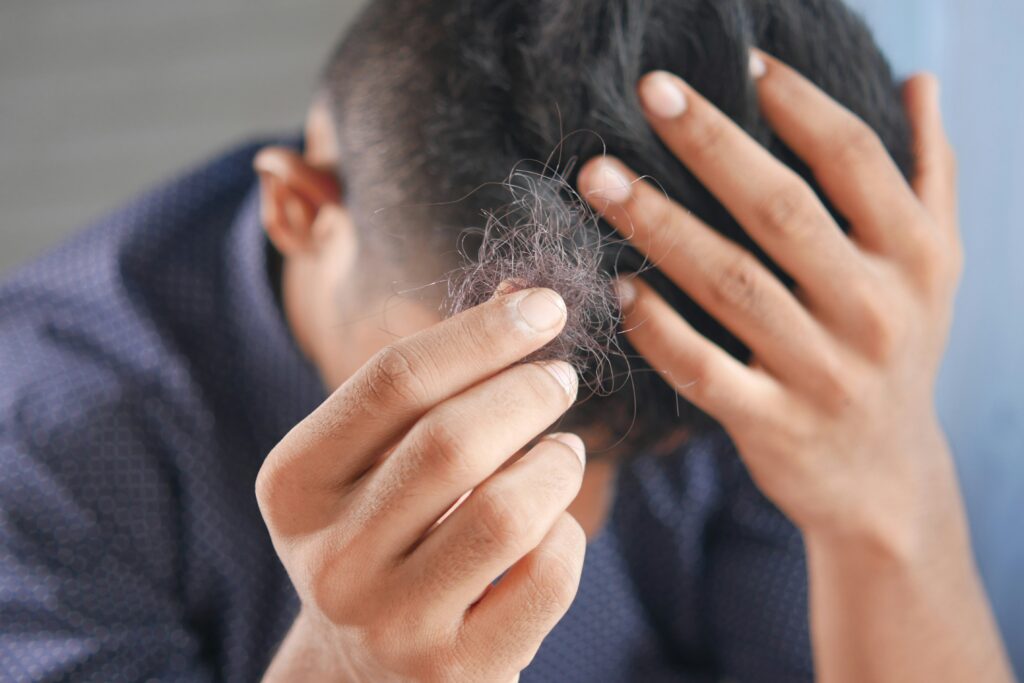 Androgenic alopecia is a common case among men because of hormones inbalance.