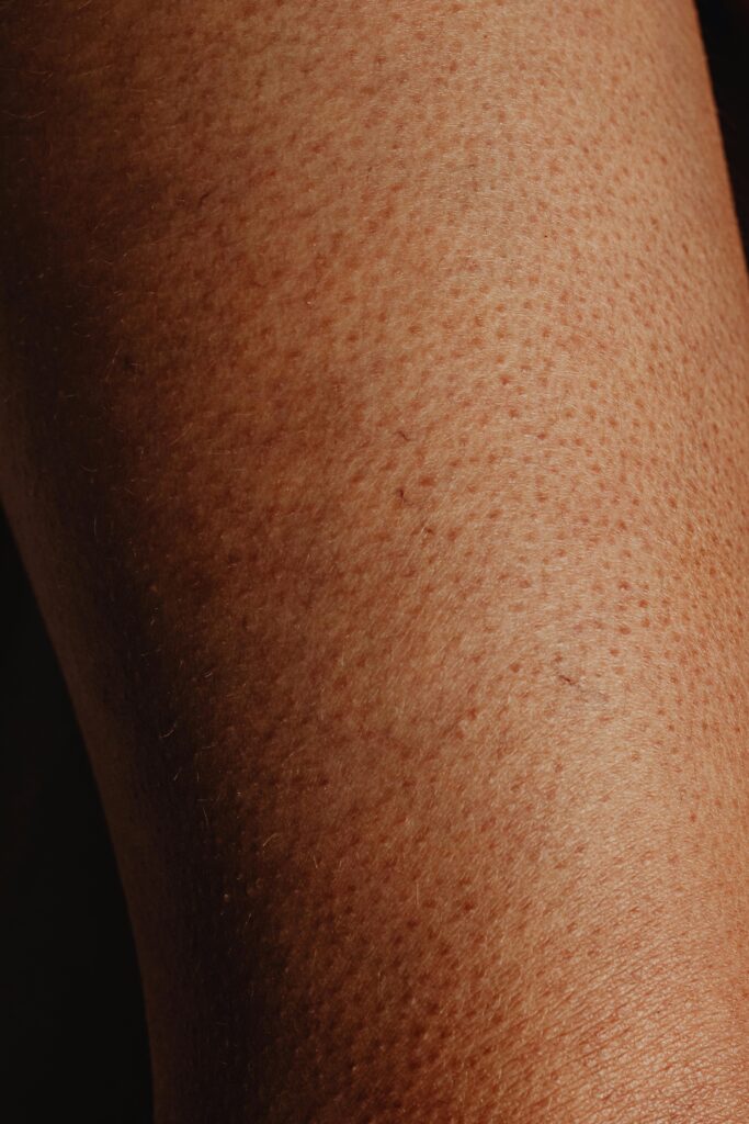 Keratosis pilaris happens because of the accumulation of keratin on both skin and hair follicles.