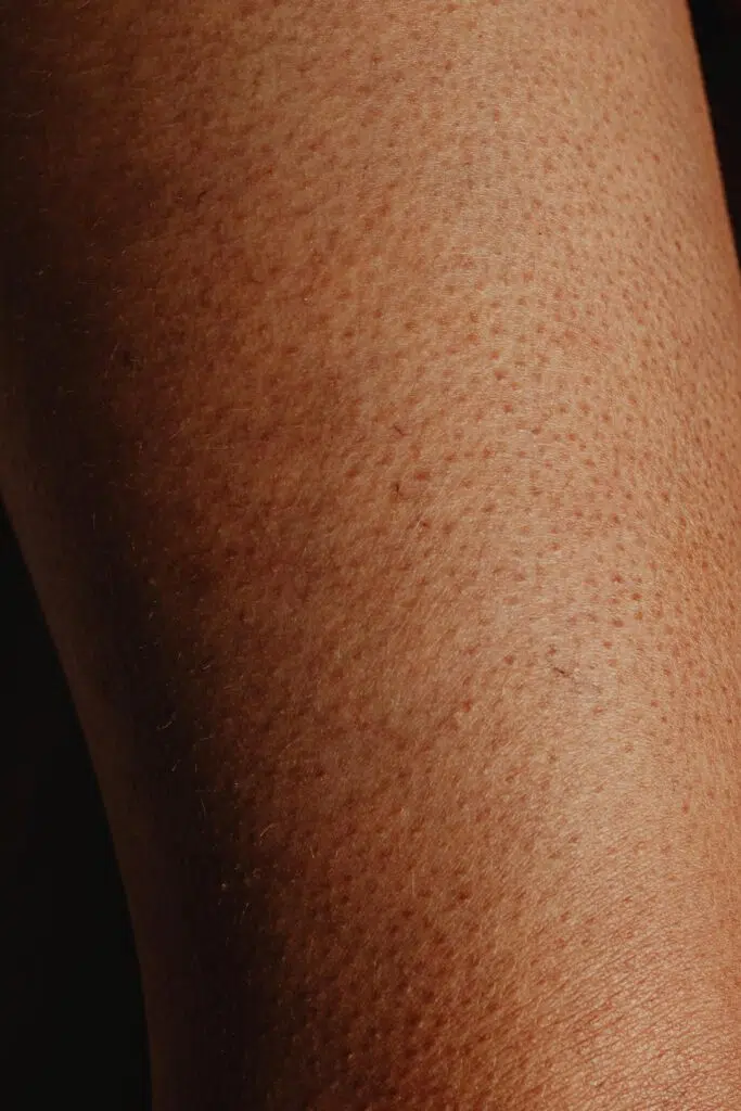 Keratosis pilaris happens because of the accumulation of keratin on both skin and hair follicles.
