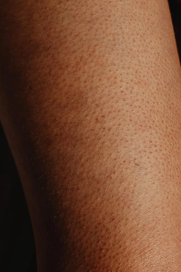 Keratosis pilaris happens because of the accumulation of keratin on both skin and hair follicles.