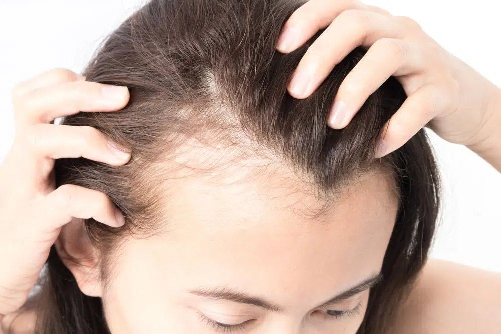 اعراض تساقط الشعر