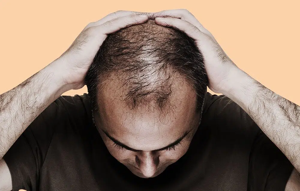 علاج الشعر الخفيف والمتساقط،اسباب تساقط الشعر
